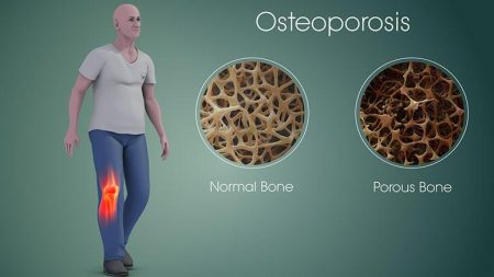 Osteoporosis Stages And Symptoms Entirely Health