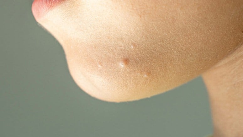 Molluscum Contagiosum Symptoms Causes Treatment Entirely Health