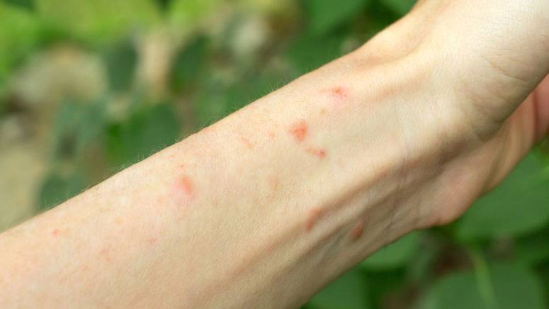 Poison Ivy Oak Sumac Facts You Need To Know Page Entirely Health