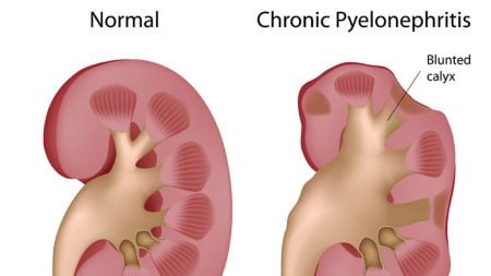 The Symptoms of Kidney Infection (Pyelonephritis) – Page 3 – Entirely ...