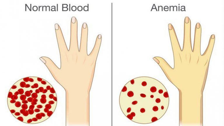 What Causes Anemia? – Page 4 – Entirely Health