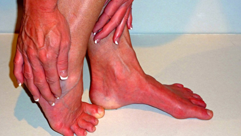 Burning Foot Pain Causes – Page 6 – Entirely Health
