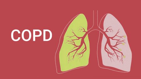 What Are The Four Stages Of COPD? – Entirely Health