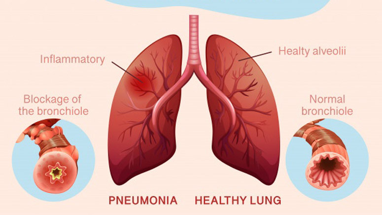 Pneumonia Diagnosis, Treatment And Recovery – Entirely Health