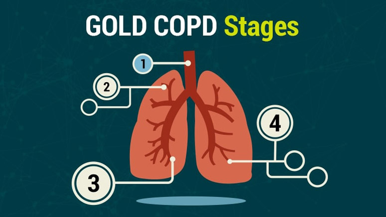 4 Stages Of Copd