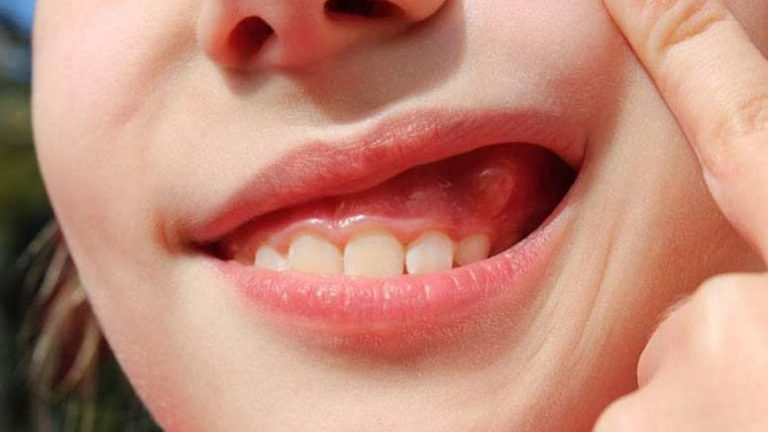 at home remedies for mouth infection