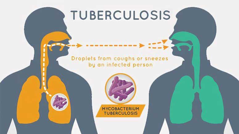 tuberculosis-symptoms-signs-entirely-health