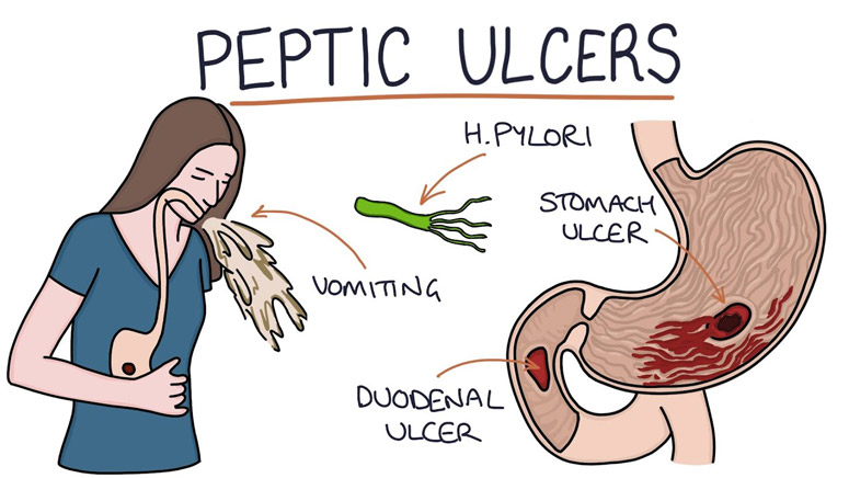 peptic-ulcer-causes-sign-symptoms-diagnosis-pathophysiology