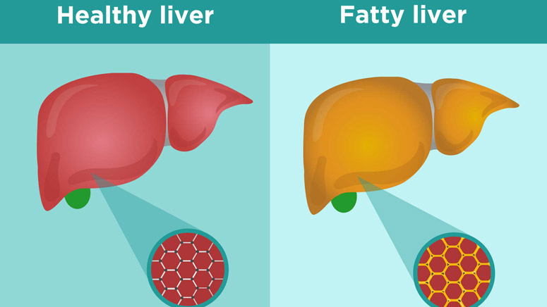 Fatty Liver (Hepatic Steatosis): Most Common Signs and Symptoms – Page