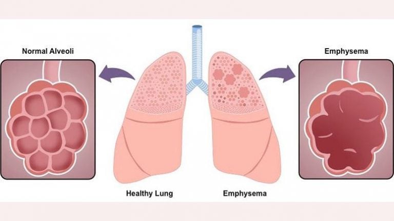 What Are The Symptoms Of Emphysema? – Entirely Health