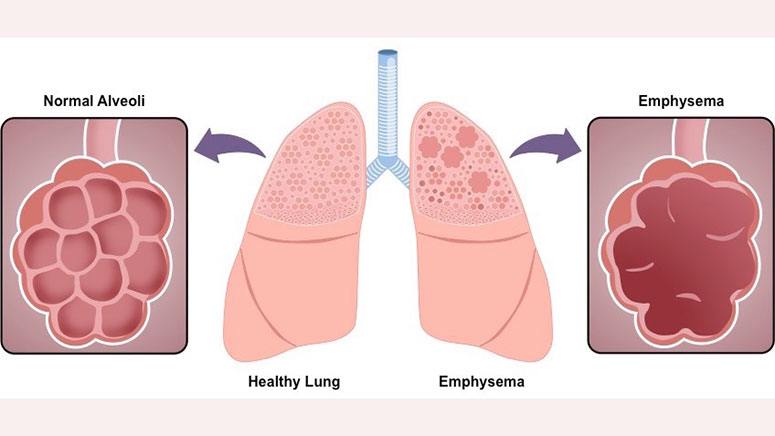 Emphysema Definition Symptoms Causes Diagnosis Types Stages