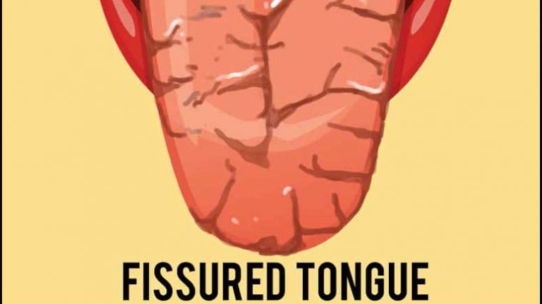 10 Common Dry Mouth Symptoms – Page 7 – Entirely Health