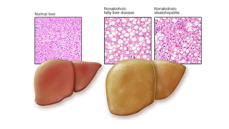 What Causes Cirrhosis of the Liver Page 4 Entirely Health