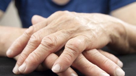 What Causes Bursitis? – Page 2 – Entirely Health