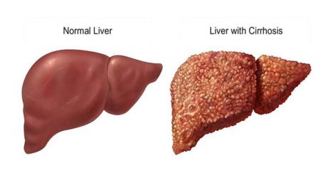 Liver Cirrhosis Management and Treatment – Entirely Health