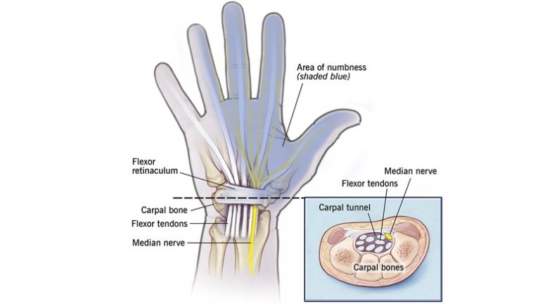 Symptoms And Risk Factors Of Carpal Tunnel Syndrome – Entirely Health