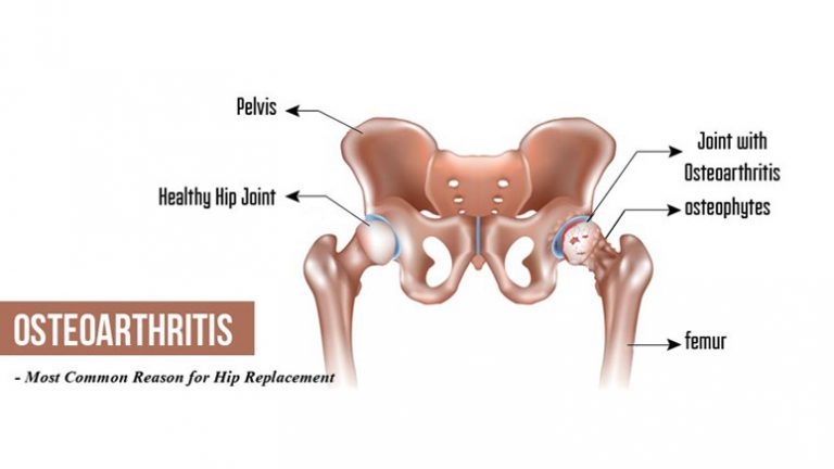 why-does-my-hip-hurt-8-causes-of-hip-pain-entirely-health