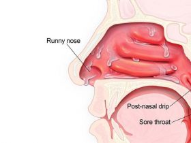 Remedies for Post Nasal Drip – Entirely Health