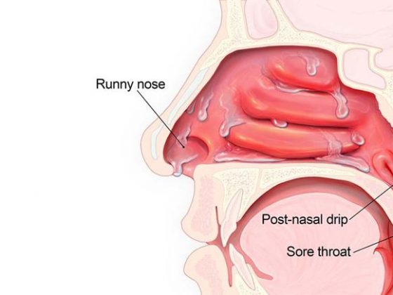 Remedies For Post Nasal Drip – Entirely Health