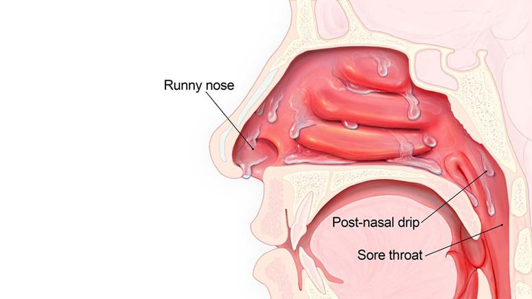 Symptoms and Potential Complications of Postnasal Drip