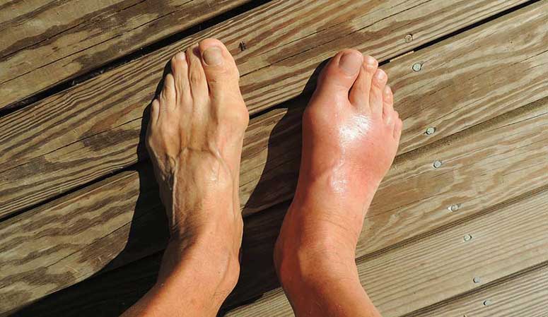 httpsconditionsgoutsome facts that you should know are about gout gouty arthritis3