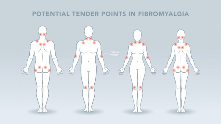 Symptoms Of Fibromyalgia Syndrome Entirely Health