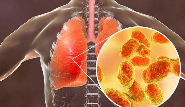 Some Types of Pneumonia – Entirely Health