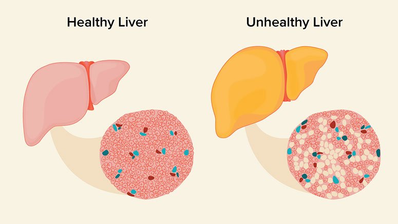 Home Treatments for Fatty Liver – Entirely Health