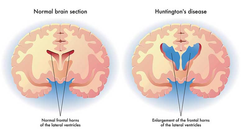 7 Type Of Dementia Page 7 Entirely Health