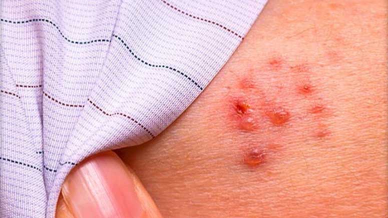 shingles pictures and symptoms