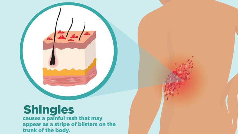 Signs & Symptoms of Shingles – Page 2 – Entirely Health