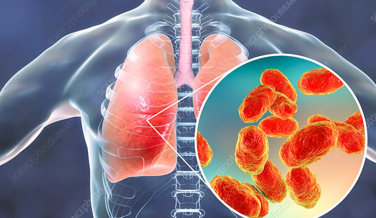 Symptoms and Complications of Bacterial Pneumonia – Entirely Health