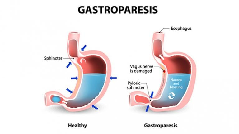 gastroparesis-symptoms-complications-diagnosis-entirely-health