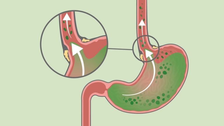 Common Symptoms of Hiatal Hernia – Page 2 – Entirely Health