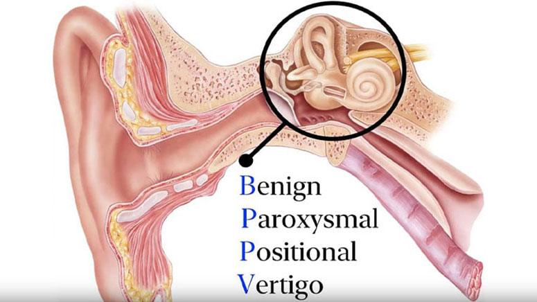 8 Facts Of Vertigo Symptoms Causes And Treatments Page 3 Entirely Health