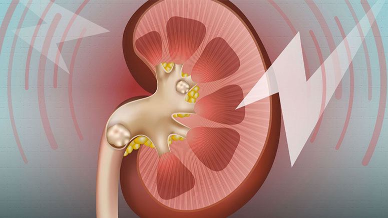 Home Remedies for Kidney Stones Entirely Health