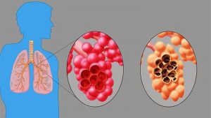 Treatment Options for Emphysema – Entirely Health