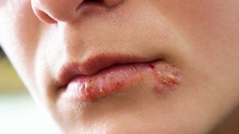 symptoms-and-signs-of-herpes-page-3-entirely-health