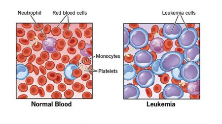 Leukopenia: 10 Facts to know – Page 2 – Entirely Health