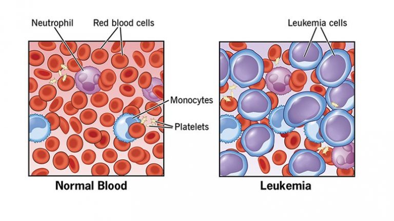 Leukopenia: 10 Facts to know – Page 2 – Entirely Health
