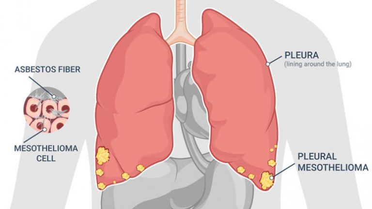 Different Types and Symptoms of Mesothelioma – Page 2 – Entirely Health