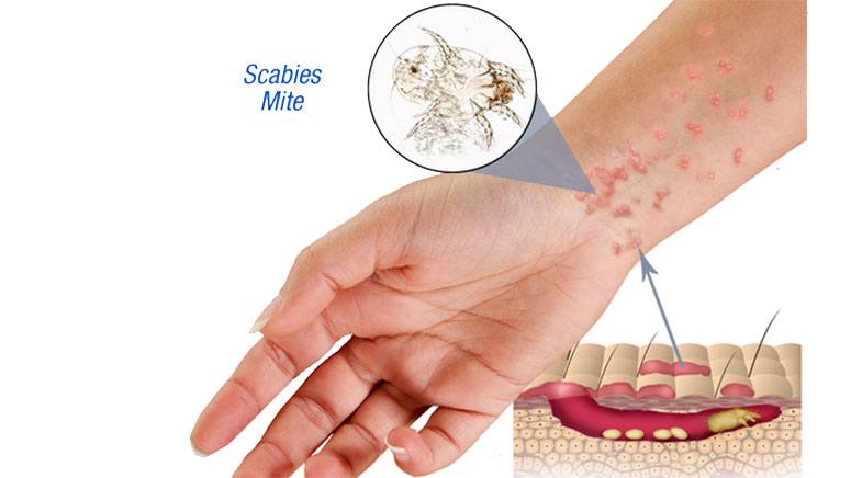 what kills scabies fast