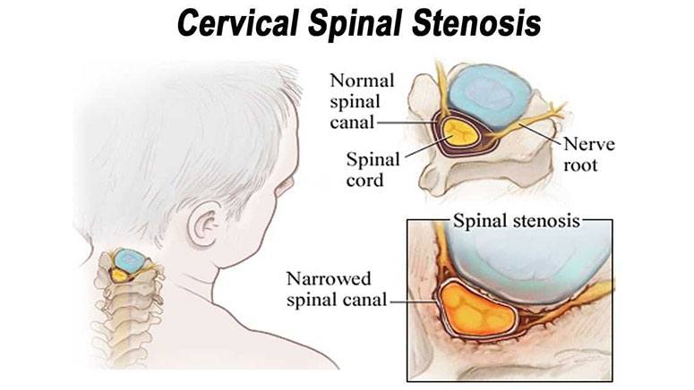 Common Symptoms of Cervical Spinal Stenosis – Entirely Health