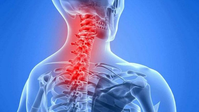Common Symptoms of Cervical Spinal Stenosis – Page 2 – Entirely Health