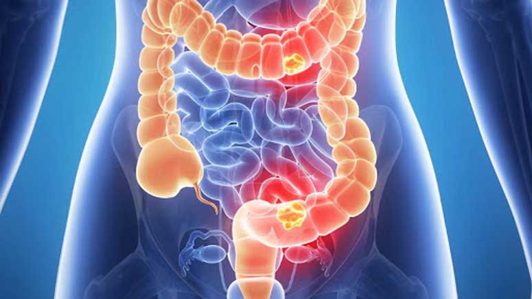 9 Symptoms of Clostridium Difficile Colitis – Entirely Health