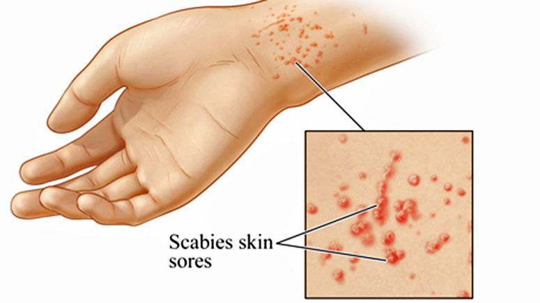 Scabies Symptoms And Causes Page 5 Entirely Health