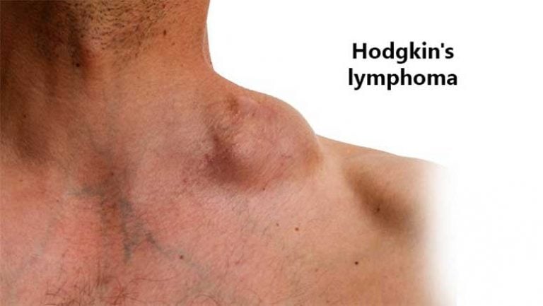 some-facts-about-hodgkin-lymphoma-entirely-health