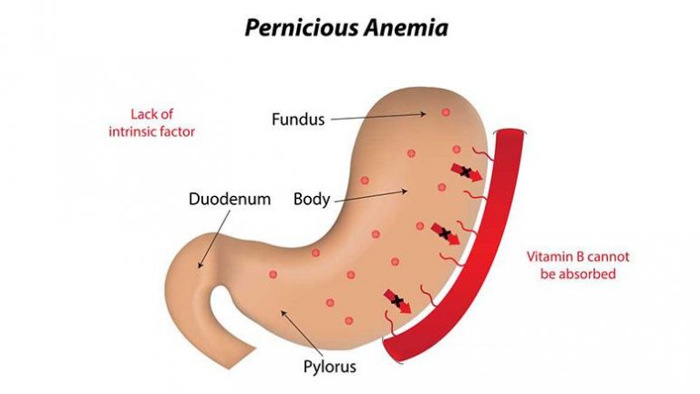 Pernicious Anemia Common Symptoms To Learn Entirely Health 6944