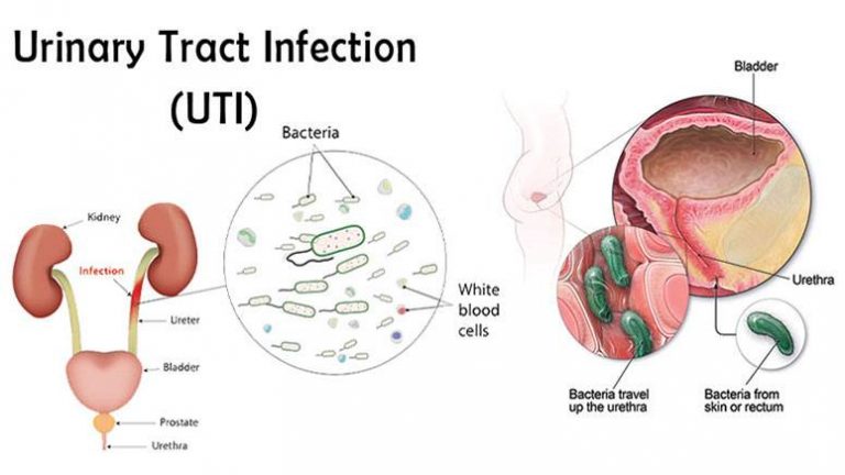 symptoms-and-causes-of-hematuria-blood-in-the-urine-page-5