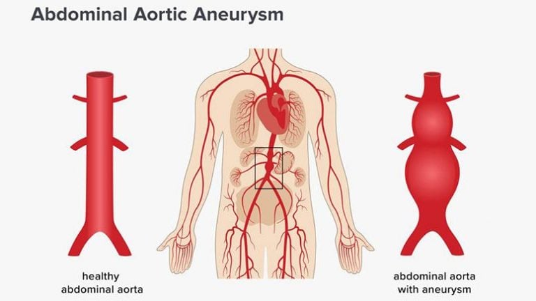 aneurysm-types-symptoms-causes-page-3-entirely-health